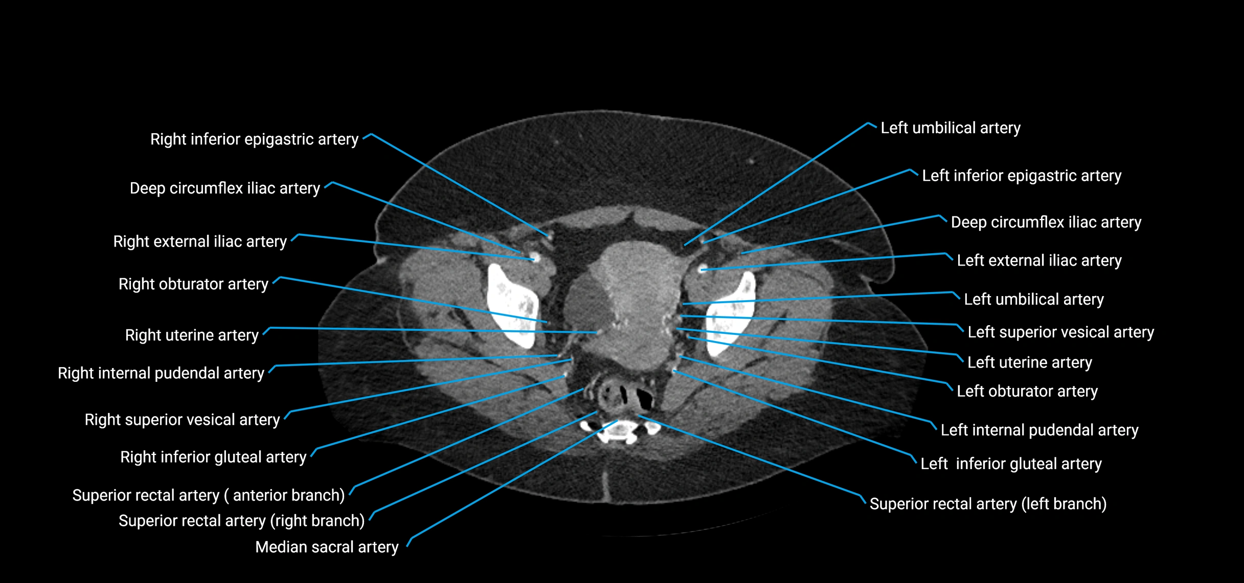 CTA abdomen axial cross sectional anatomy labelled image_226 (2).webp